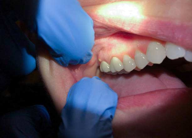 Best Dentist for Tooth Abscess  in Chinchilla, PA